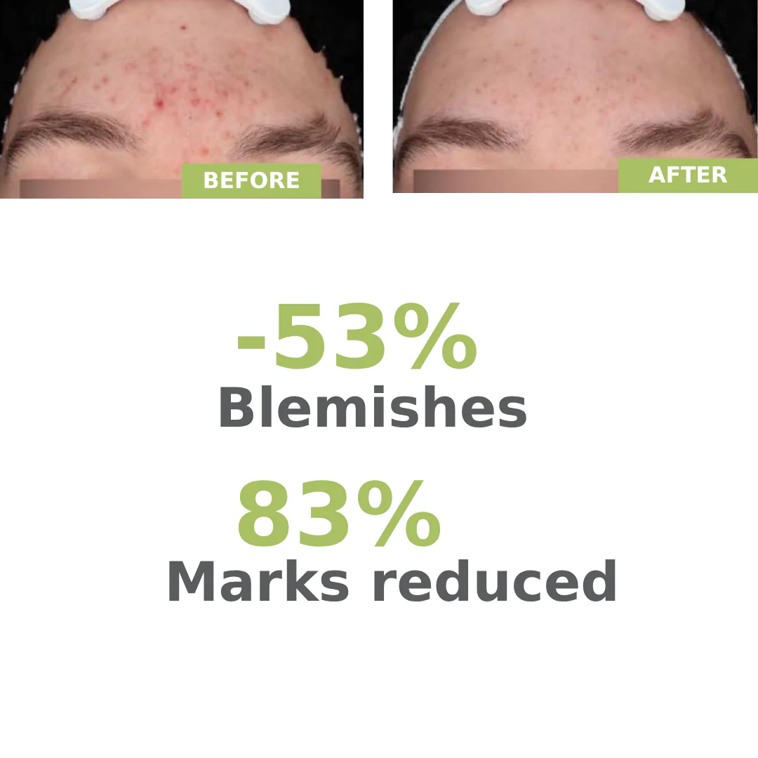 A-derma Biology AC Night Peel Anti-Blemish Serum 30ml - Image 7
