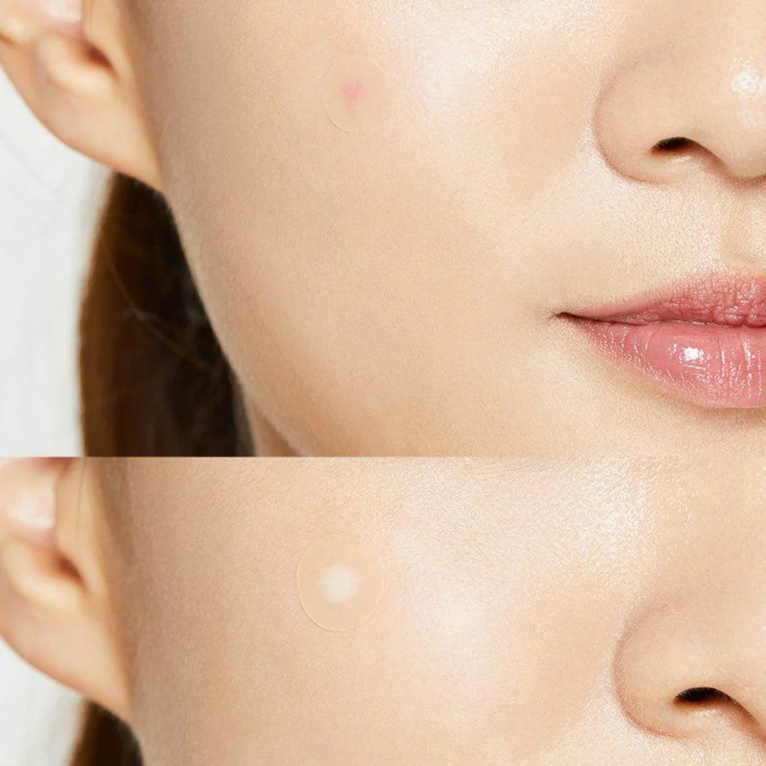 Cosrx Acne Pimple Master Patch - Image 3