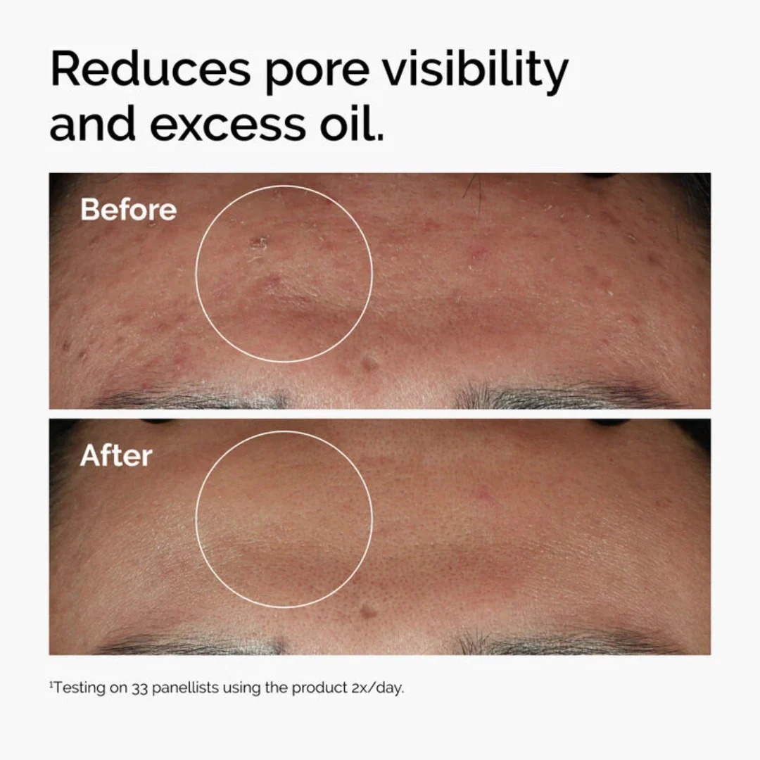 The Ordinary Niacinamide 10% + Zinc 1% Serum For Oily Skin - Image 5
